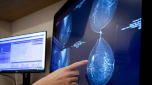 Yeni yapay zeka modeli 5 yıla kadarki meme kanseri riskini tahmin ediyor